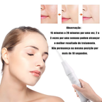 Aparelho Alta Frequência Portátil Ozônio Tratamento de Pele Facial e Capilar Removedor de Acne Cravos 4 ou 5 Eletrodos